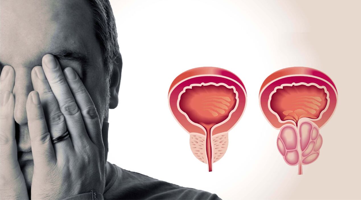 przewlekłe zapalenie prostaty u mężczyzn