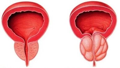 zdrowa i zapalona prostata z zapaleniem prostaty